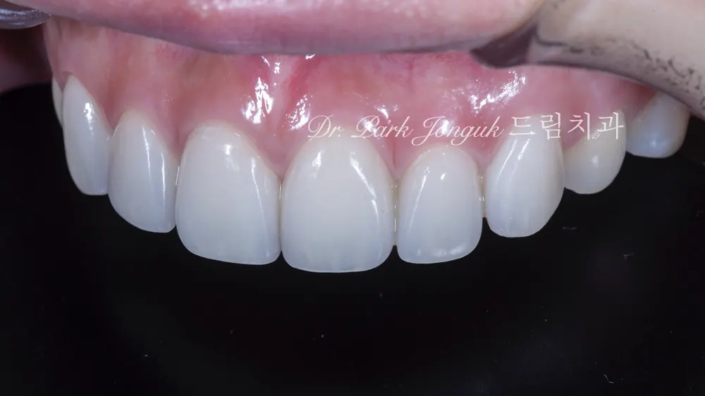 Natural Veneers: Confidence Regained Through the Handmade Method After a Same-Day Failure — photo 6