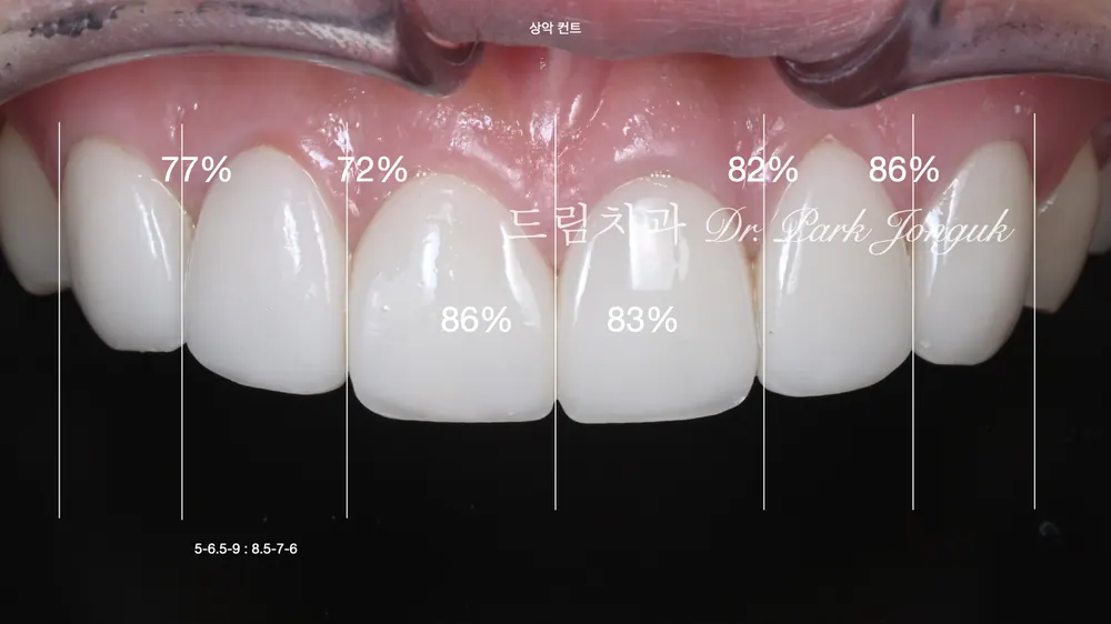 ラミネート再治療症例｜人工的なワンデーラミネートを自然に治し直した過程 — 写真2