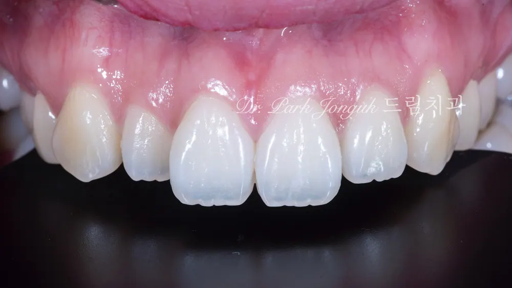 Buck Front Teeth Veneer Treatment: A Natural Result Through Minimal-Reduction Precision Diagnosis — photo 1