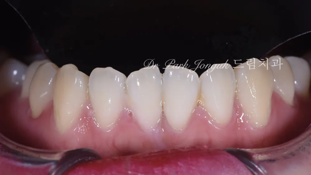 Buck Front Teeth Veneer Treatment: A Natural Result Through Minimal-Reduction Precision Diagnosis — photo 5