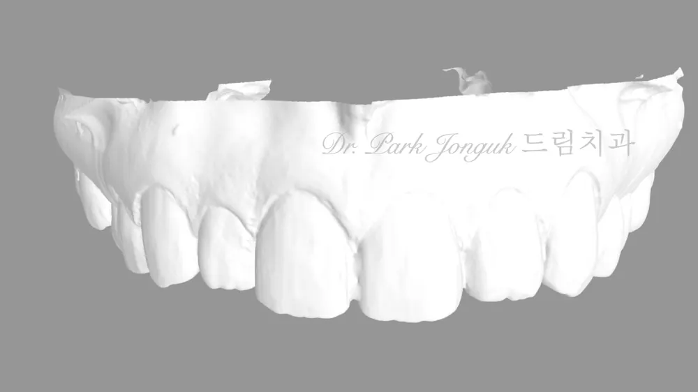 Buck Front Teeth Veneer Treatment: A Natural Result Through Minimal-Reduction Precision Diagnosis — photo 8