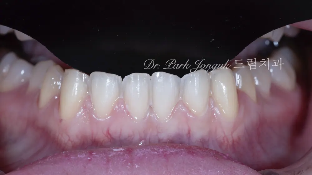 Buck Front Teeth Veneer Treatment: A Natural Result Through Minimal-Reduction Precision Diagnosis — photo 11