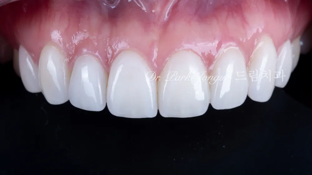Buck Front Teeth Veneer Treatment: A Natural Result Through Minimal-Reduction Precision Diagnosis — photo 18