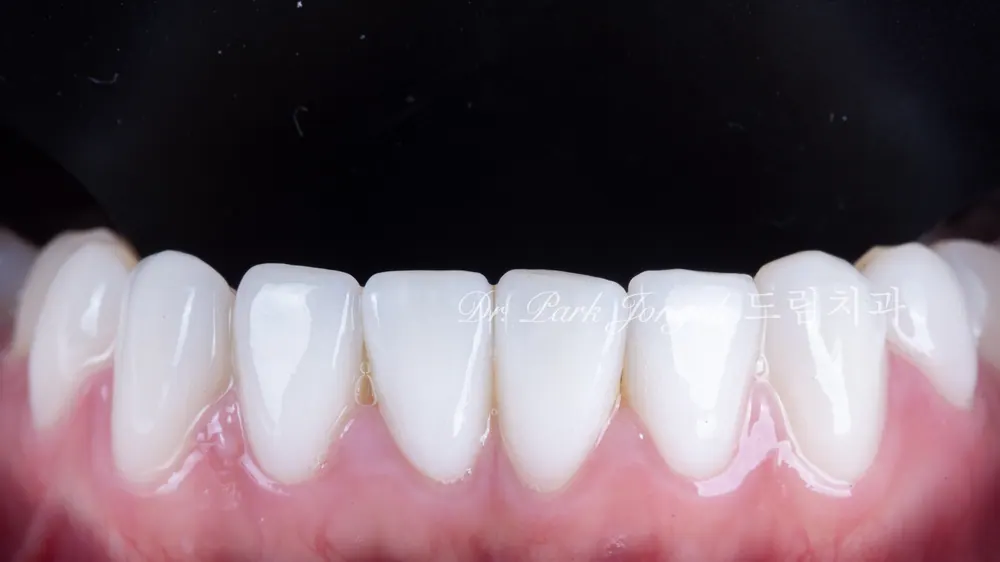 Buck Front Teeth Veneer Treatment: A Natural Result Through Minimal-Reduction Precision Diagnosis — photo 19