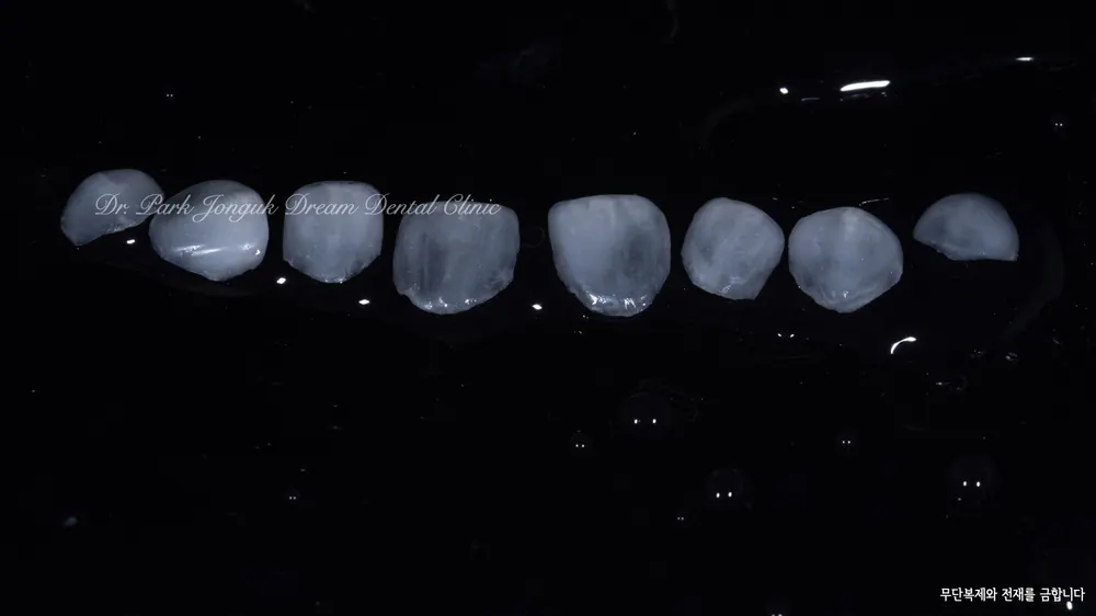 ラミネートベニアとは何か? | 自然なラミネートベニアのための基本ガイド — 写真7