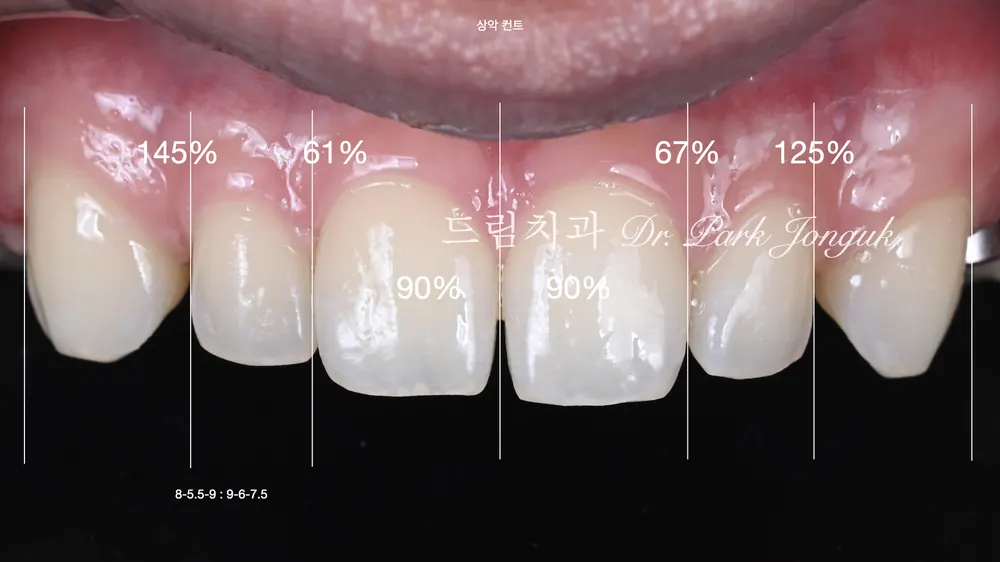 不磨牙瓷贴面｜适用条件与自然效果真实案例 — 图2