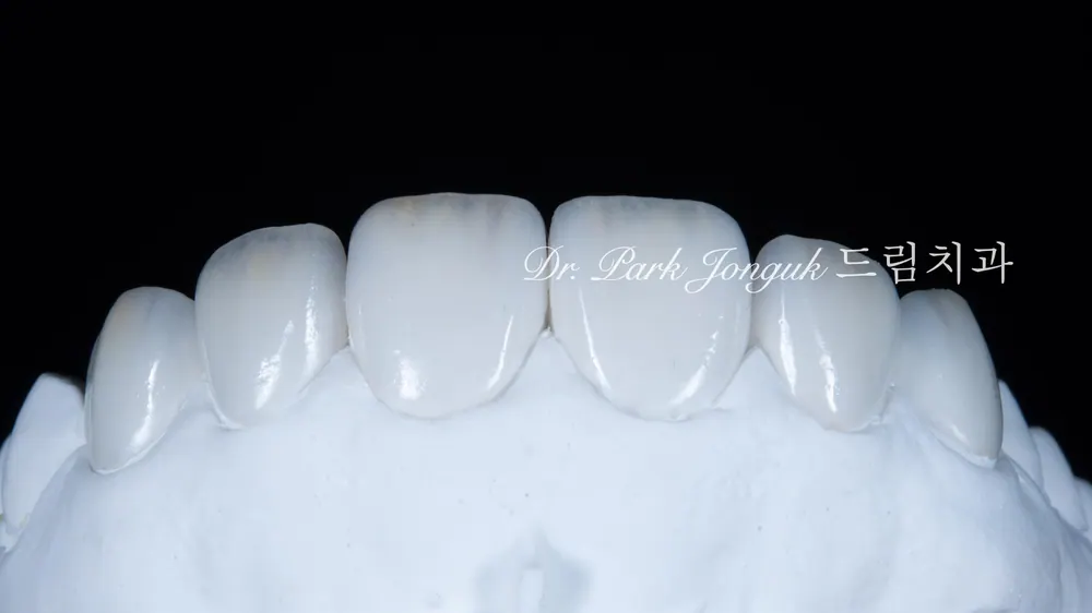 Chế tác veneer không mài răng tự nhiên