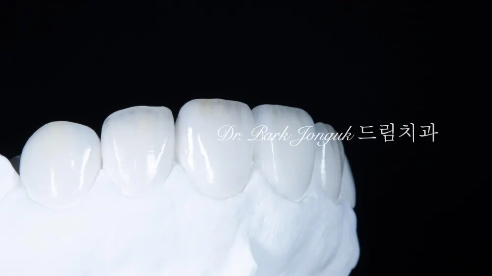 Veneer không mài răng cửa | Cách hoàn thiện nụ cười tự nhiên trong khi vẫn giữ gìn răng thật — ảnh 3