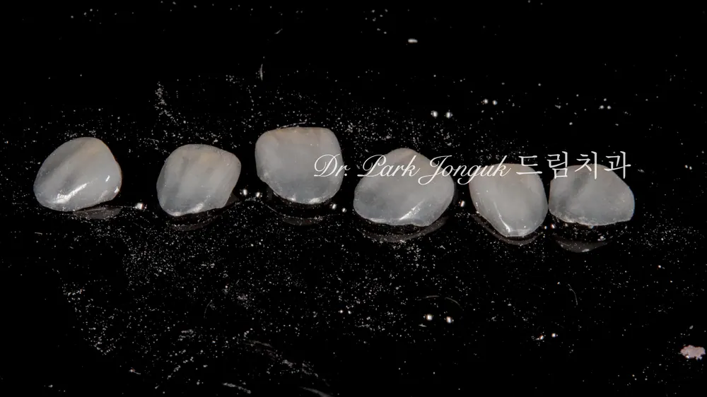 Veneer không mài răng cửa | Cách hoàn thiện nụ cười tự nhiên trong khi vẫn giữ gìn răng thật — ảnh 4