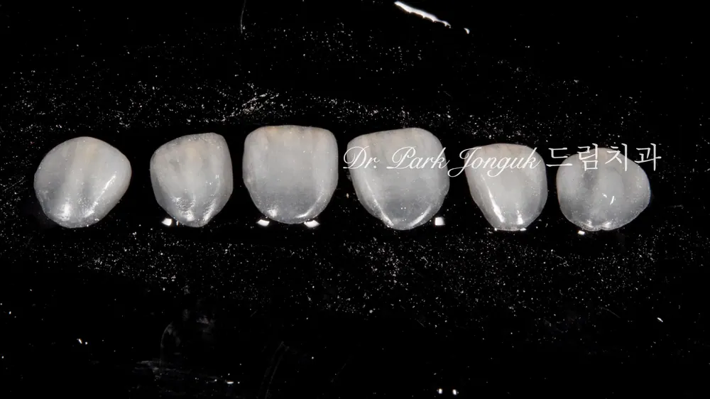 Veneer không mài răng cửa | Cách hoàn thiện nụ cười tự nhiên trong khi vẫn giữ gìn răng thật — ảnh 5