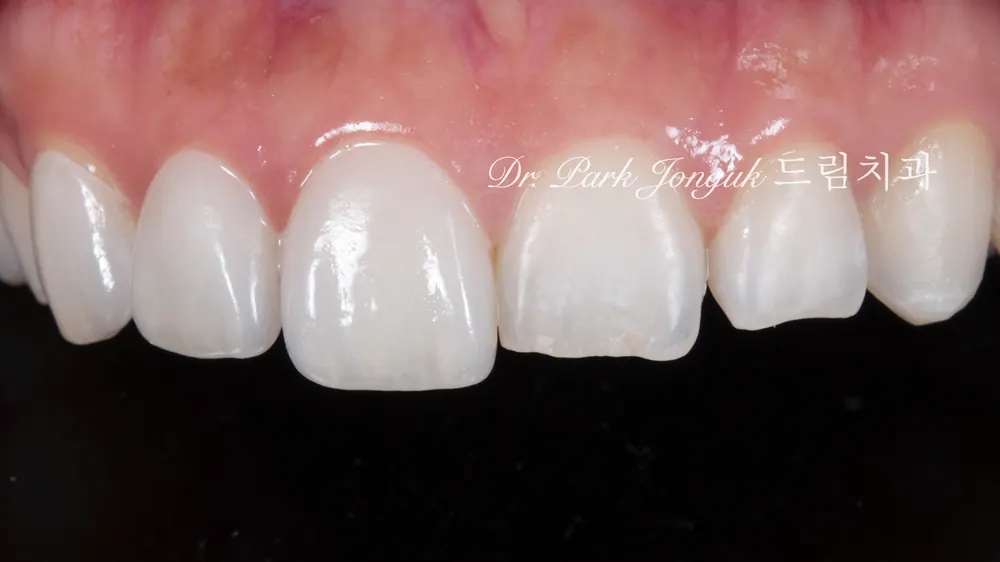 Veneer không mài răng