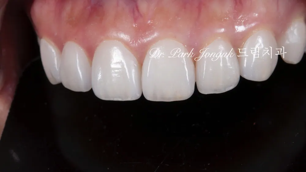 Veneer không mài răng cửa | Cách hoàn thiện nụ cười tự nhiên trong khi vẫn giữ gìn răng thật — ảnh 8