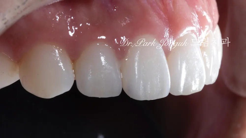 Veneer không mài răng cửa | Cách hoàn thiện nụ cười tự nhiên trong khi vẫn giữ gìn răng thật — ảnh 9