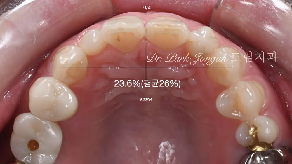 50대 여성의 왜소치·기형치 라미네이트｜두려움을 극복하고 자연스러운 미소를 되찾다 본문 사진 3