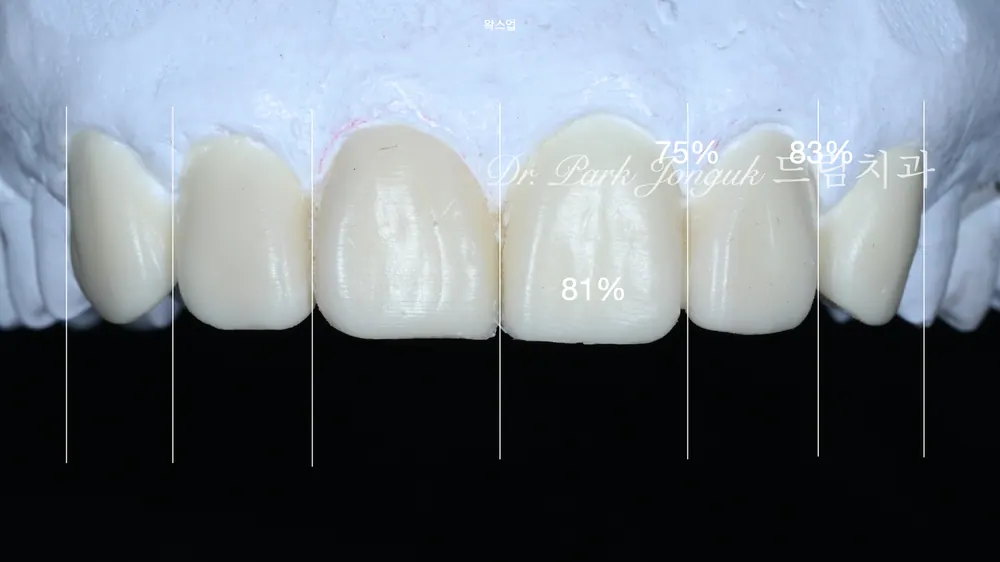 Kết quả điều trị Veneer quá mức và quy trình làm lại | Ca lâm sàng trở lại nụ cười tự nhiên — ảnh 6
