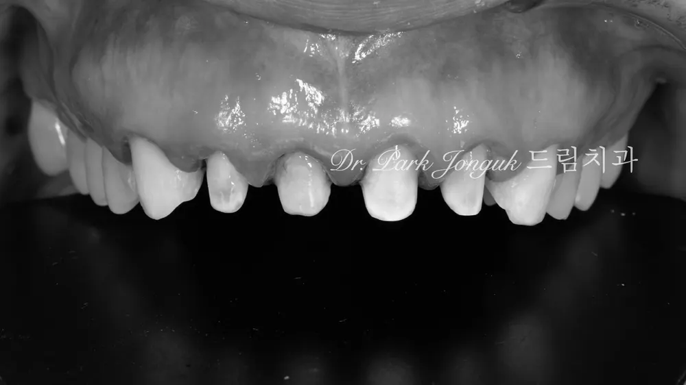 Làm lại Veneer — sau khi tháo bỏ Veneer cũ