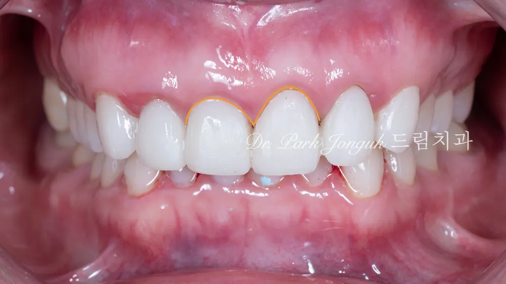 Làm lại Veneer — giai đoạn răng tạm