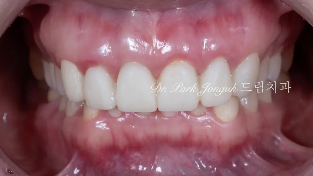 Làm lại Veneer — giai đoạn răng tạm