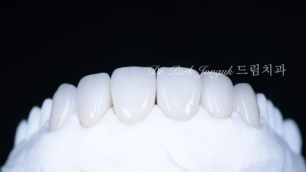 Làm lại Veneer