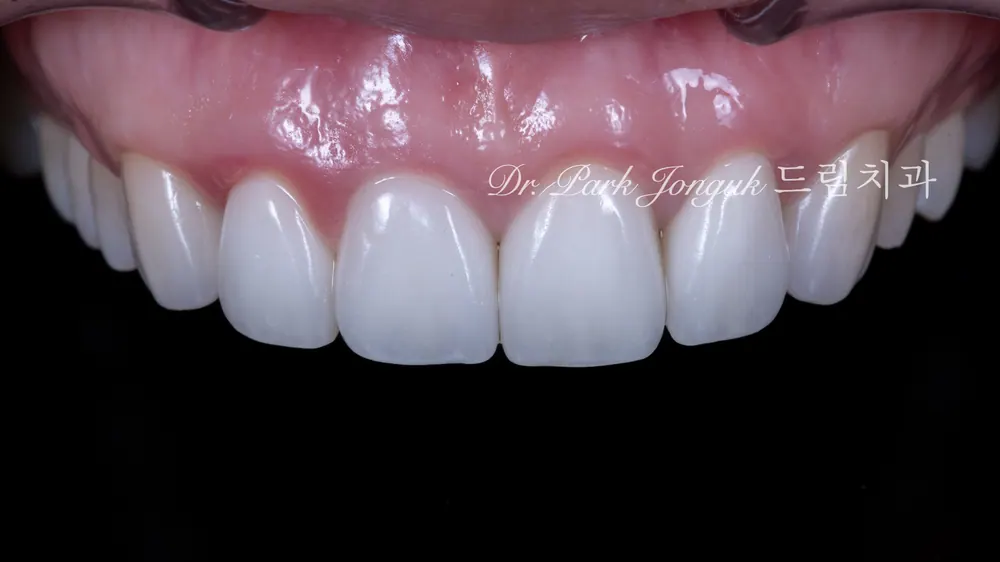 Làm lại Veneer
