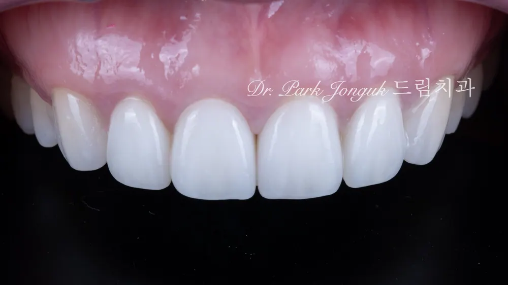 Làm lại Veneer