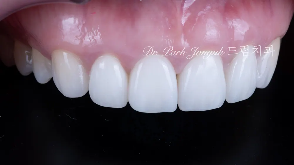 Kết quả điều trị Veneer quá mức và quy trình làm lại | Ca lâm sàng trở lại nụ cười tự nhiên — ảnh 13