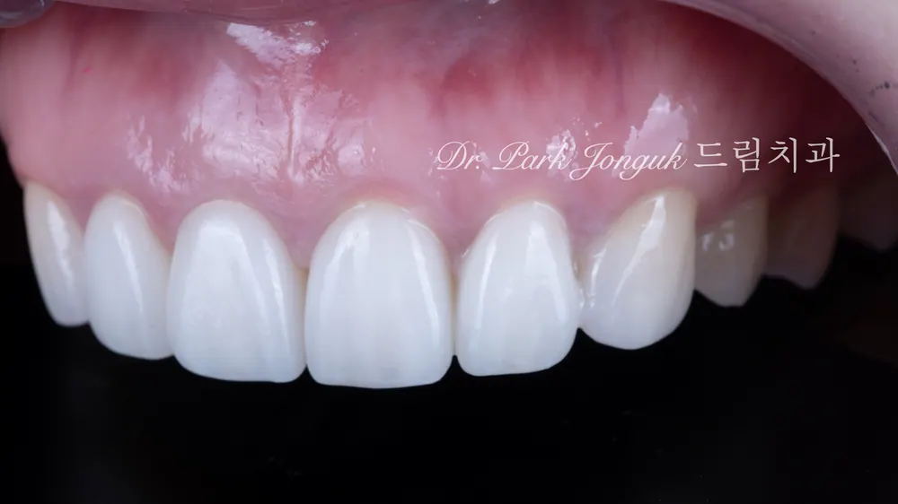 Kết quả điều trị Veneer quá mức và quy trình làm lại | Ca lâm sàng trở lại nụ cười tự nhiên — ảnh 14
