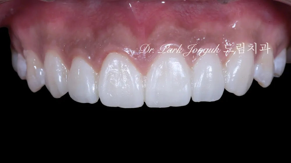 Răng tạm — yếu tố bắt buộc trong Veneer không mài răng