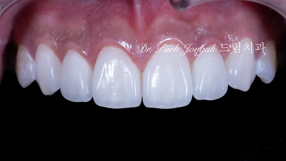 Hoàn thành Veneer không mài răng