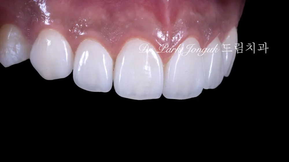 Veneer không mài răng