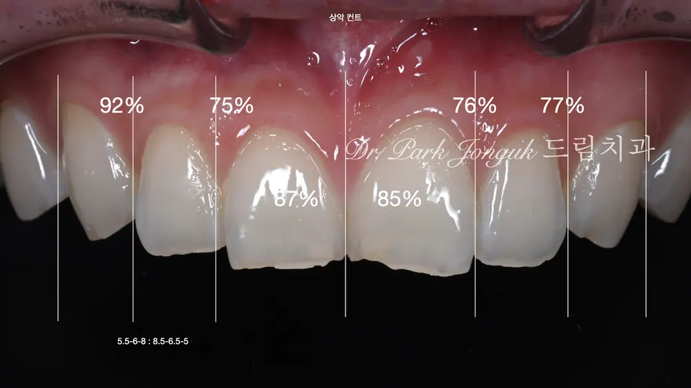 Quy trình chẩn đoán chính xác cho Veneer