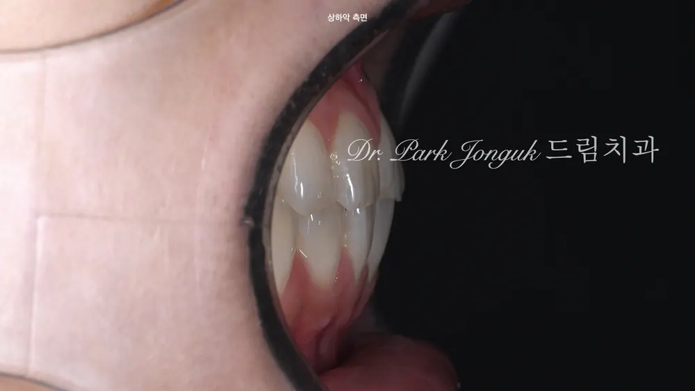 Veneer chỉ hai răng cửa: phục hồi tự nhiên với mài răng tối thiểu, gần như không mài răng — ảnh 3