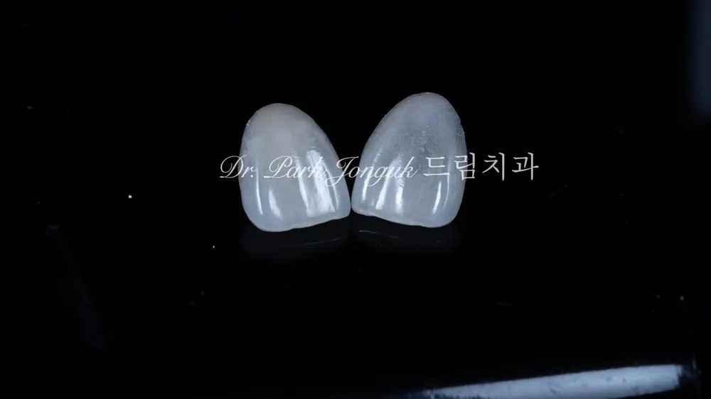 Chế tác Veneer tự nhiên