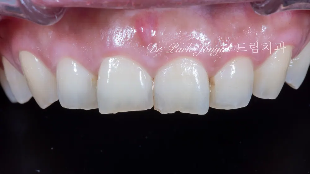 The patient visited for veneer treatment due to tooth wear and aging.