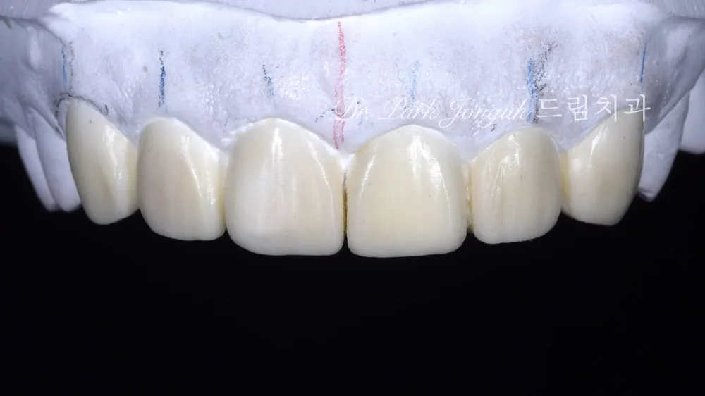 Precision wax-up diagnosis for veneers