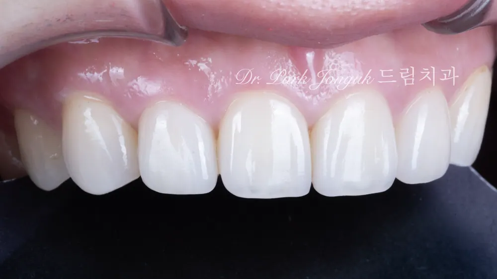 Natural, beautiful micro-reduction no-prep veneers