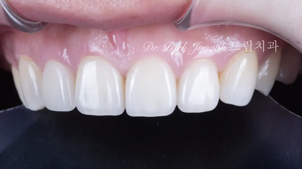 Natural, beautiful micro-reduction no-prep veneers