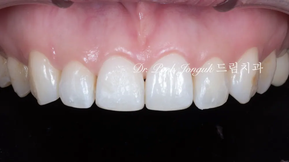 Đến khám để điều trị veneer sau chỉnh nha