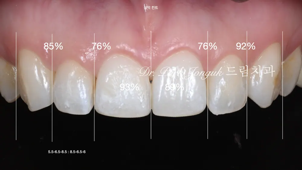 Chẩn đoán wax-up cho veneer sau chỉnh nha
