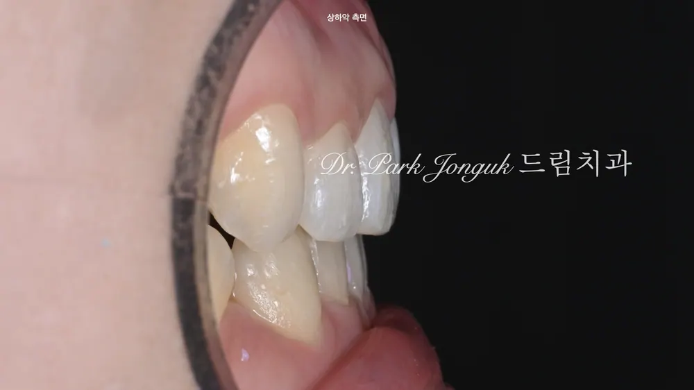 Veneer sau chỉnh nha: điều trị thẩm mỹ mài răng tối thiểu, hoàn thiện sự tự nhiên mà không làm to thêm kích thước răng — ảnh 3