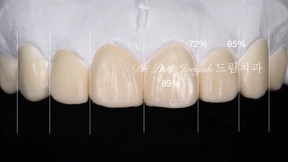Veneer sau chỉnh nha: điều trị thẩm mỹ mài răng tối thiểu, hoàn thiện sự tự nhiên mà không làm to thêm kích thước răng — ảnh 5