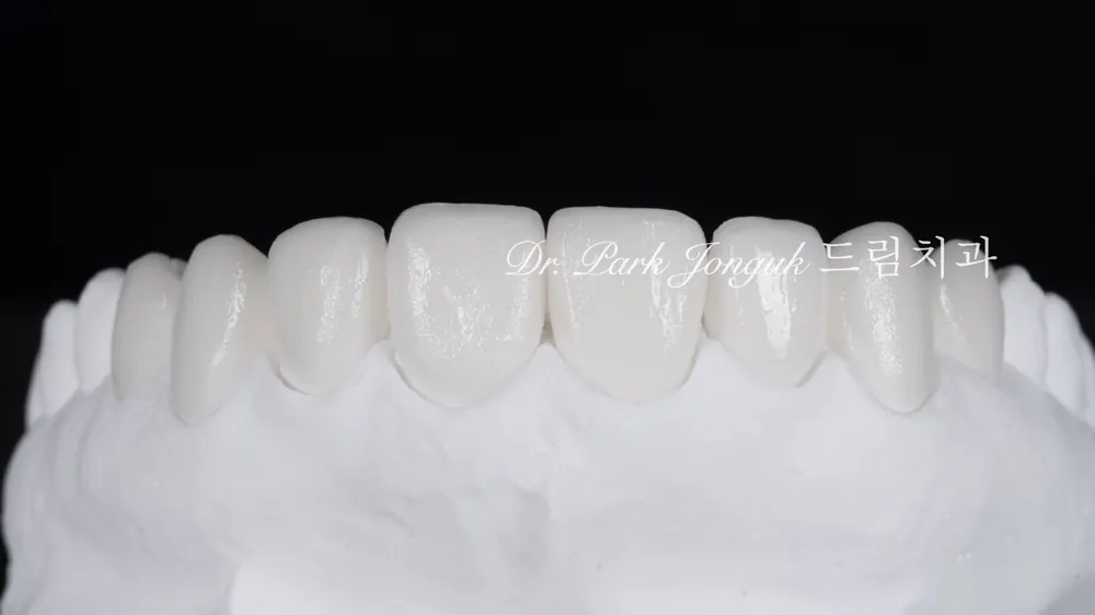 Quy trình chế tác veneer thủ công có công đoạn đắp sứ nhiều lớp