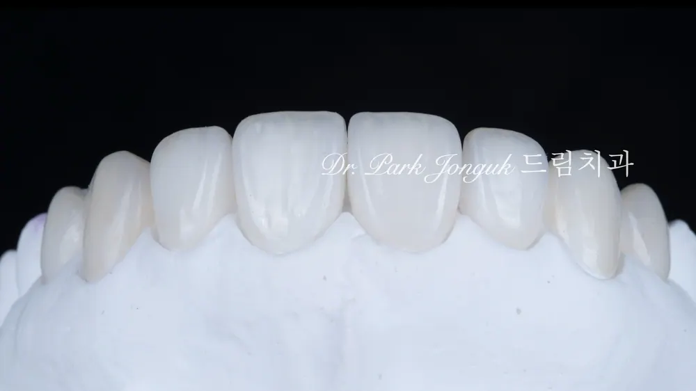 Veneer tự nhiên và đẹp