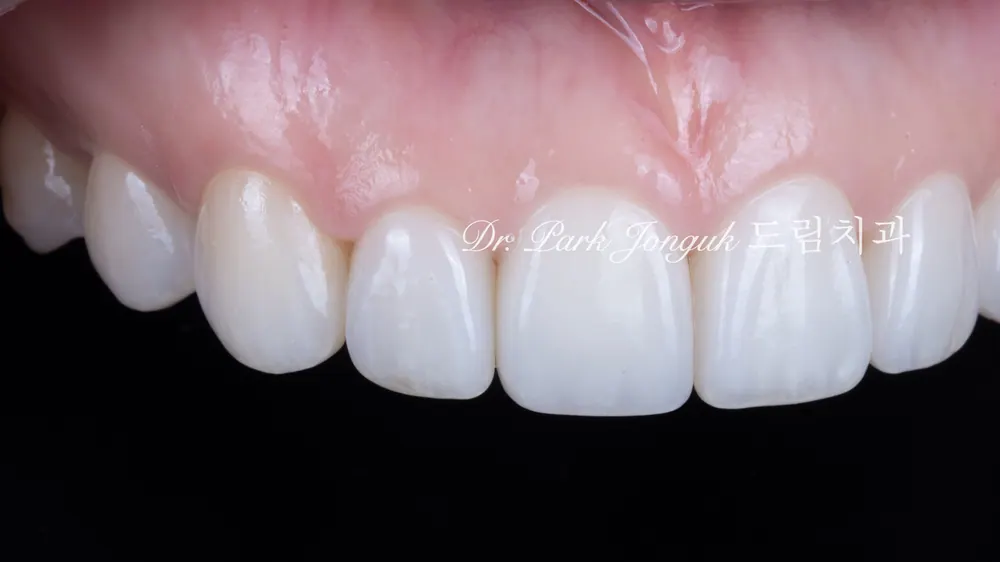 Veneer tự nhiên và đẹp