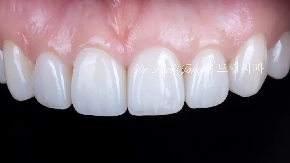 Veneer tự nhiên và đẹp