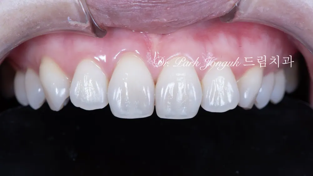 She came in for veneer treatment to improve both the shape of her teeth and the discoloration.