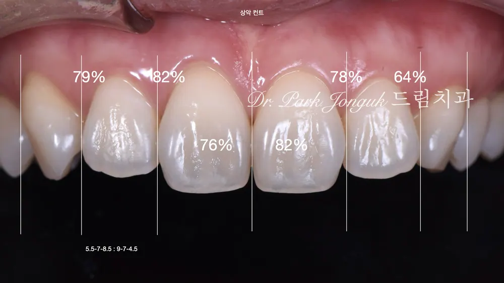 Precision wax-up diagnosis for the veneers