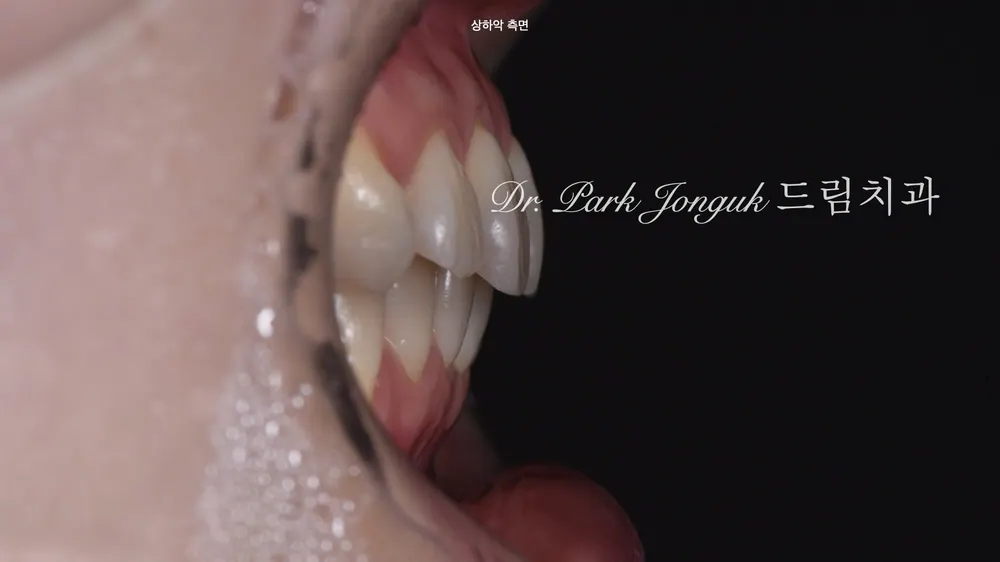 Naturally Brightening Dark, Discolored Teeth | The Answer for Discolored-Tooth Veneers — photo 4