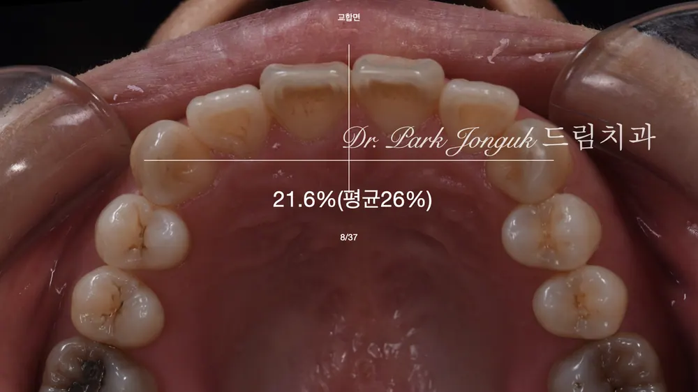 Precision wax-up diagnosis for the veneers