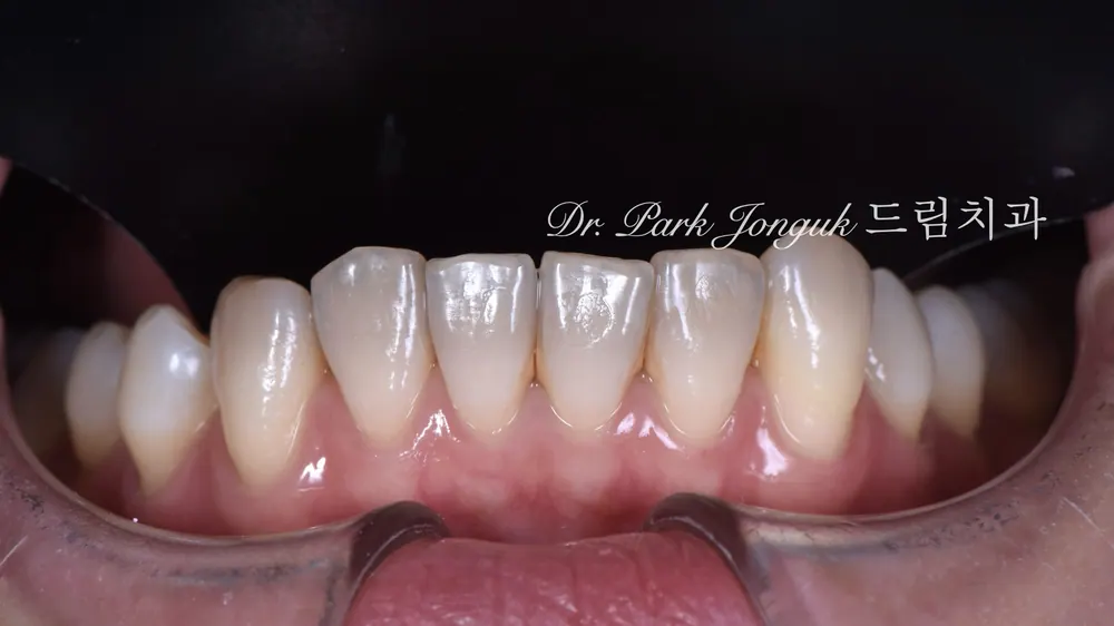 Precision wax-up diagnosis for the veneers